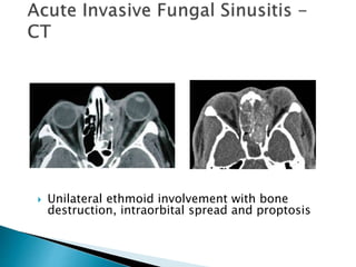 Unilateral ethmoid involvement with bone
destruction, intraorbital spread and proptosis
 