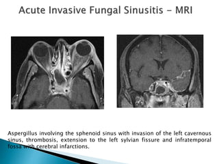 Aspergillus involving the sphenoid sinus with invasion of the left cavernous
sinus, thrombosis, extension to the left sylvian fissure and infratemporal
fossa with cerebral infarctions.
 