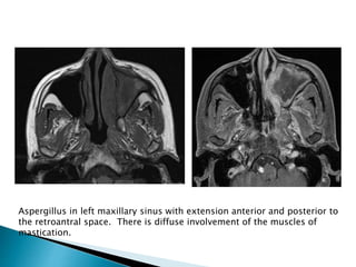 Aspergillus in left maxillary sinus with extension anterior and posterior to
the retroantral space. There is diffuse involvement of the muscles of
mastication.
 