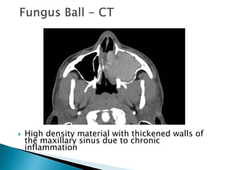  High density material with thickened walls of
the maxillary sinus due to chronic
inflammation
 