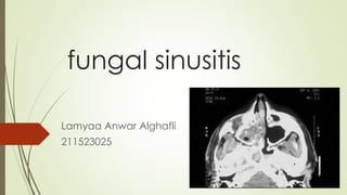 fungal sinusitis
Lamyaa Anwar Alghafli
211523025
 