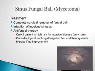  Treatment
Complete surgical removal of fungal ball
Irrigation of involved sinuses
Antifungal therapy
○ Only if patient is high risk for invasive disease (very rare)
○ Consider topical antifungal irrigation first and then systemic
therapy if no improvement
 