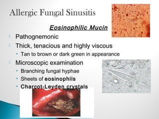 Eosinophilic Mucin
 Pathognemonic
 Thick, tenacious and highly viscous
• Tan to brown or dark green in appearance
 Microscopic examination
• Branching fungal hyphae
• Sheets of eosinophils
• Charcot-Leyden crystals
 