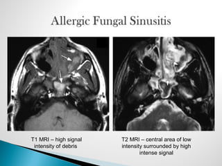 T1 MRI – high signal
intensity of debris
T2 MRI – central area of low
intensity surrounded by high
intense signal
 