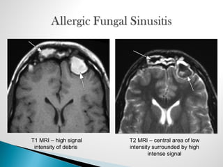 T1 MRI – high signal
intensity of debris
T2 MRI – central area of low
intensity surrounded by high
intense signal
 