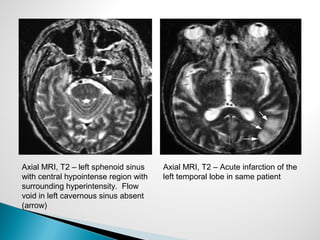 Axial MRI, T2 – left sphenoid sinus
with central hypointense region with
surrounding hyperintensity. Flow
void in left cavernous sinus absent
(arrow)
Axial MRI, T2 – Acute infarction of the
left temporal lobe in same patient
 