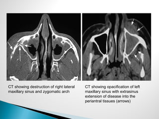 CT showing destruction of right lateral
maxillary sinus and zygomatic arch
CT showing opacification of left
maxillary sinus with extrasinus
extension of disease into the
periantral tissues (arrows)
 
