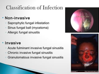  Non-invasive
◦ Saprophytic fungal infestation
◦ Sinus fungal ball (mycetoma)
◦ Allergic fungal sinusitis
 Invasive
◦ Acute fulminant invasive fungal sinusitis
◦ Chronic invasive fungal sinusitis
◦ Granulomatous invasive fungal sinusitis
 
