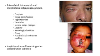 • Intraorbital, intracranial and
maxillofacial extension is common
• Proptosis
• Visual disturbances
• Hypertelorism
• Headache
• Mental status changes
• Seizures
• Neurological deficits
• Coma
• Maxillofacial soft tissue
swelling
• Angioinvasion and haematogenous
dissemination common
 