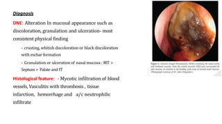 Diagnosis
DNE: Alteration In mucosal appearance such as
discoloration, granulation and ulceration- most
consistent physical finding
- crusting, whitish discoloration or black discoloration
with eschar formation
- Granulation or ulceration of nasal mucosa : MT >
Septum > Palate and IT
Histological feature: - Mycotic infiltration of blood
vessels, Vasculitis with thrombosis , tissue
infarction, hemorrhage and a/c neutrophilic
infiltrate
 