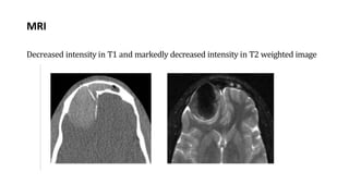 MRI
Decreased intensity in T1 and markedly decreased intensity in T2 weighted image
 
