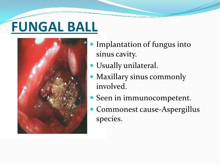 Fungal Sinusitis