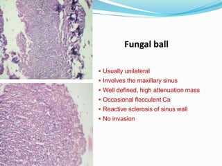 f
 Usually unilateral
 Involves the maxillary sinus
 Well defined, high attenuation mass
 Occasional flocculent Ca
 Reactive sclerosis of sinus wall
 No invasion
Fungal ball
 