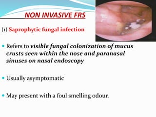 NON INVASIVE FRS
(1) Saprophytic fungal infection
 Refers to visible fungal colonization of mucus
crusts seen within the nose and paranasal
sinuses on nasal endoscopy
 Usually asymptomatic
 May present with a foul smelling odour.
 