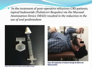  In the treatment of post-operative refractory CRS patients,
topical budesonide (Pulmicort Respules) via the Mucosal
Atomization Device (MAD) resulted in the reduction in the
use of oral prednisolone
 