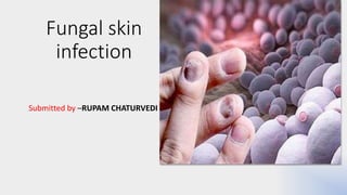 Fungal skin
infection
Submitted by –RUPAM CHATURVEDI
 