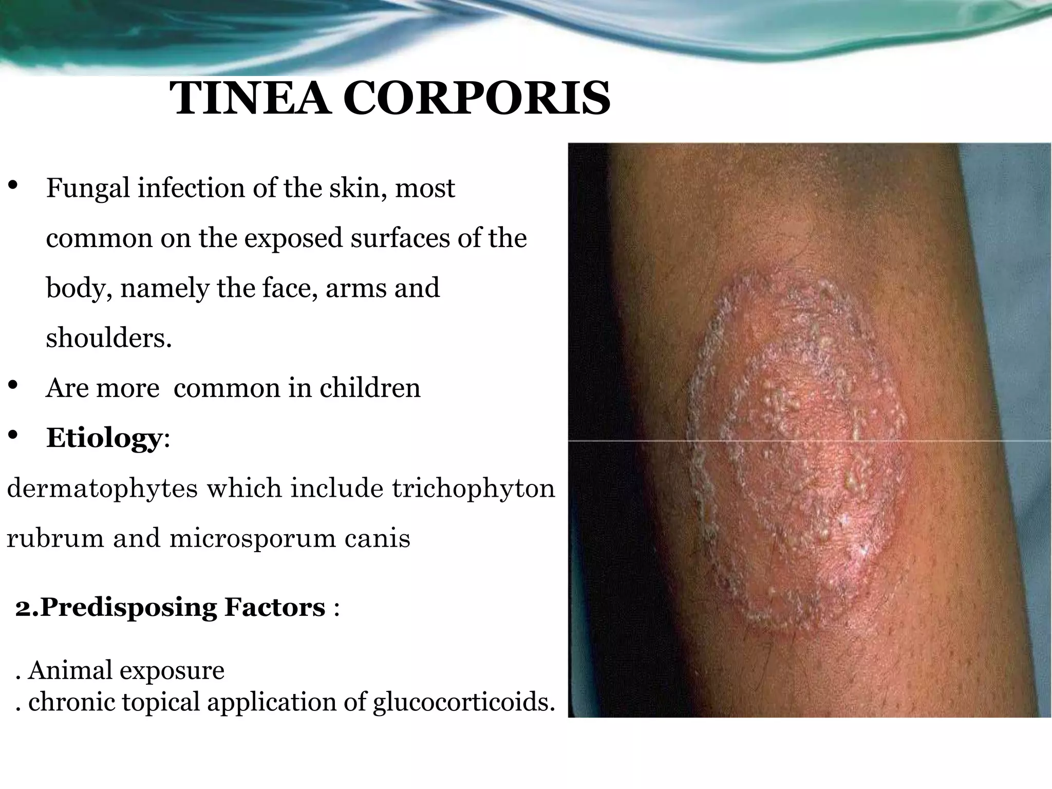 Skin Infection Color Fungal skin infection | PPTX