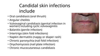 1.Fungal skin infections slideshare.pptx