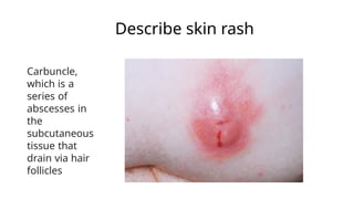 1.Fungal skin infections slideshare.pptx