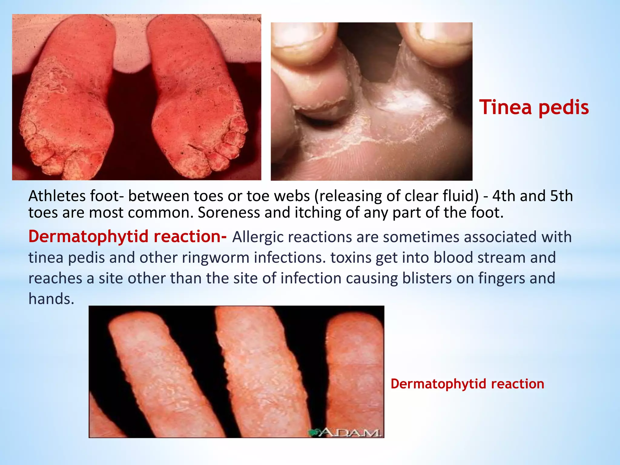 FUNGAL ZOONOSES.pptx | PPTX