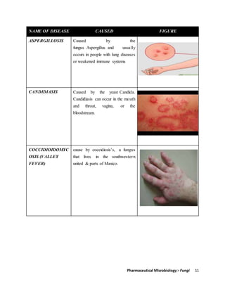 Pharmaceutical Microbiology> Fungi 11
NAME OF DISEASE CAUSED FIGURE
ASPERGILLOSIS Caused by the
fungus Aspergillus and usually
occurs in people with lung diseases
or weakened immune systems
CANDIDIASIS Caused by the yeast Candida.
Candidiasis can occur in the mouth
and throat, vagina, or the
bloodstream.
COCCIDIOIDOMYC
OSIS (VALLEY
FEVER)
cause by coccidiosis’s, a fungus
that lives in the southwestern
united & parts of Maxico.
 
