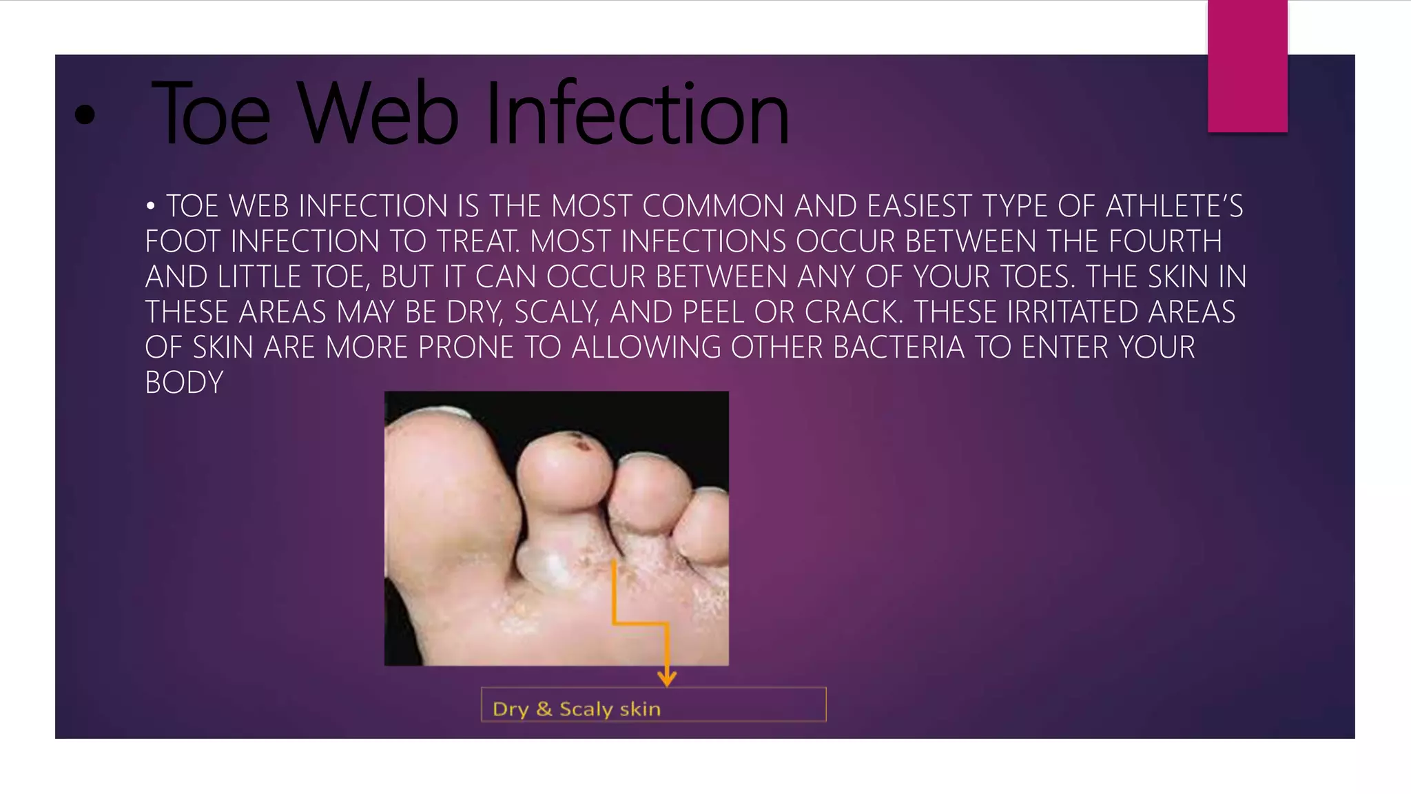 ATHLETE'S FOOT [TENEA PEDIS] FUNGI | PPTX