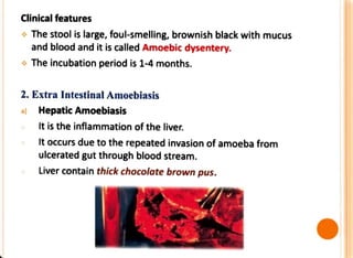 Clinical features
* The stool is large, foul-smelling, brownish black with mucus
and blood and it is called Amoebic dysentery.
* The incubation period is 1-4 months.
2. Extra Intestinal Amoebiasis
a) Hepatic Amoebiasis
It is the inflammation of the liver.
It occurs due to the repeated invasion of amoeba from
ulcerated gut through blood stream.
Liver contain thick chocolate brown pus.
 