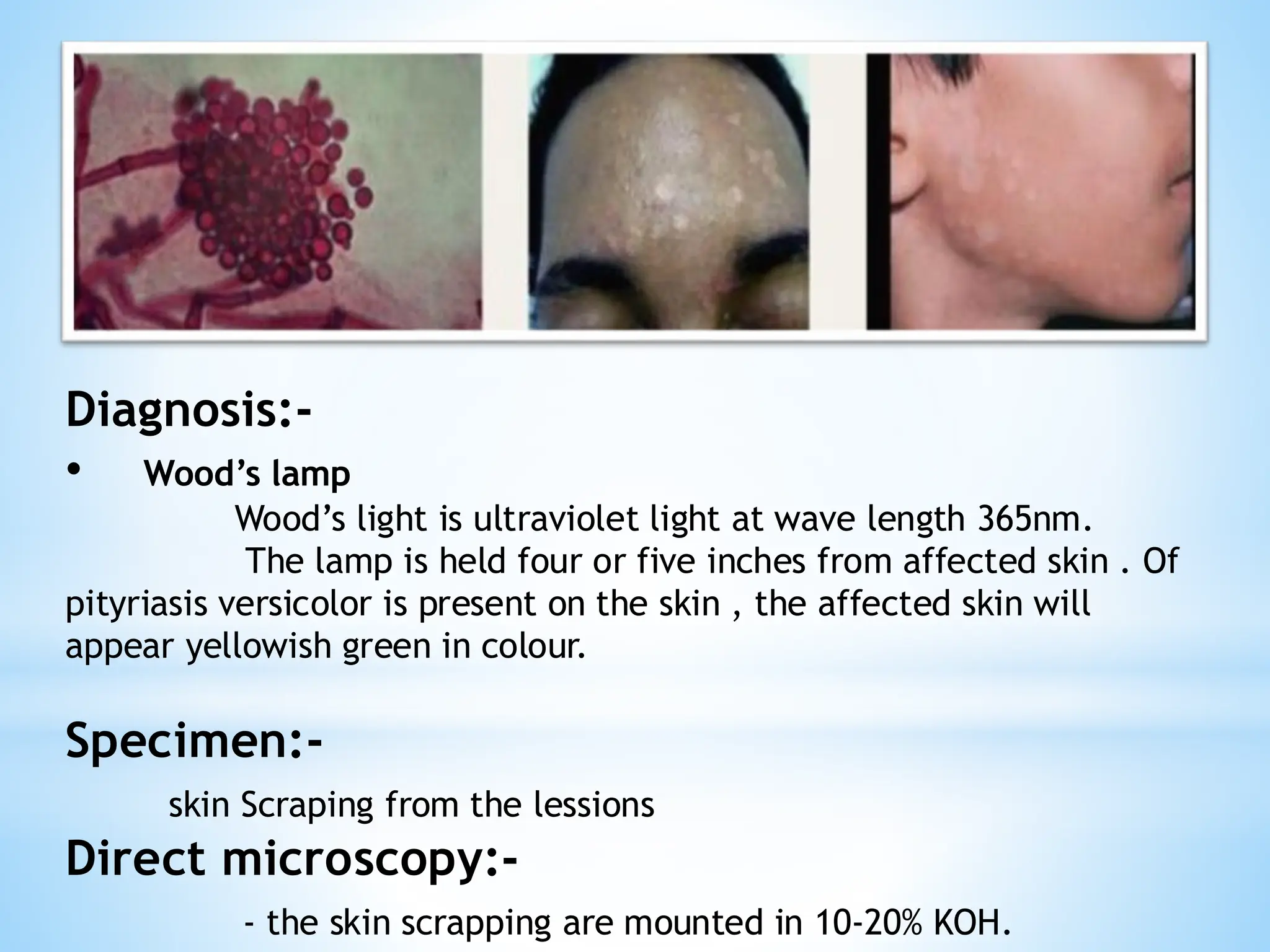 Diagnosis:-
• Wood’s lamp
Wood’s light is ultraviolet light at wave length 365nm.
The lamp is held four or five inches from affected skin . Of
pityriasis versicolor is present on the skin , the affected skin will
appear yellowish green in colour.
Specimen:-
skin Scraping from the lessions
Direct microscopy:-
- the skin scrapping are mounted in 10-20% KOH.
 