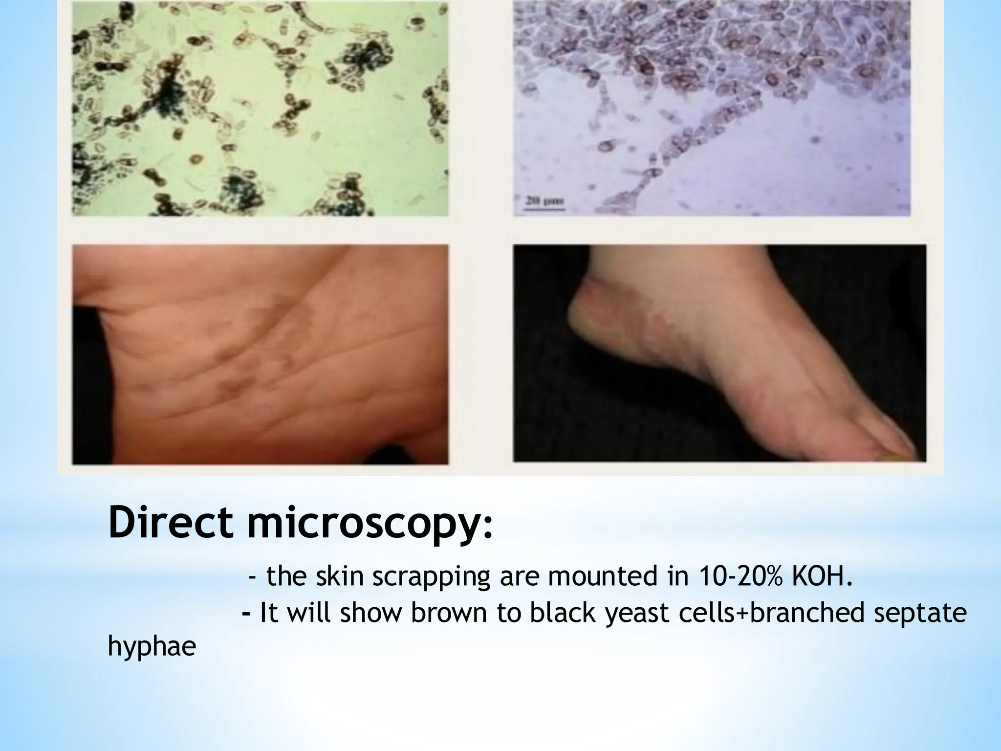 Direct microscopy:
- the skin scrapping are mounted in 10-20% KOH.
- It will show brown to black yeast cells+branched septate
hyphae
 
