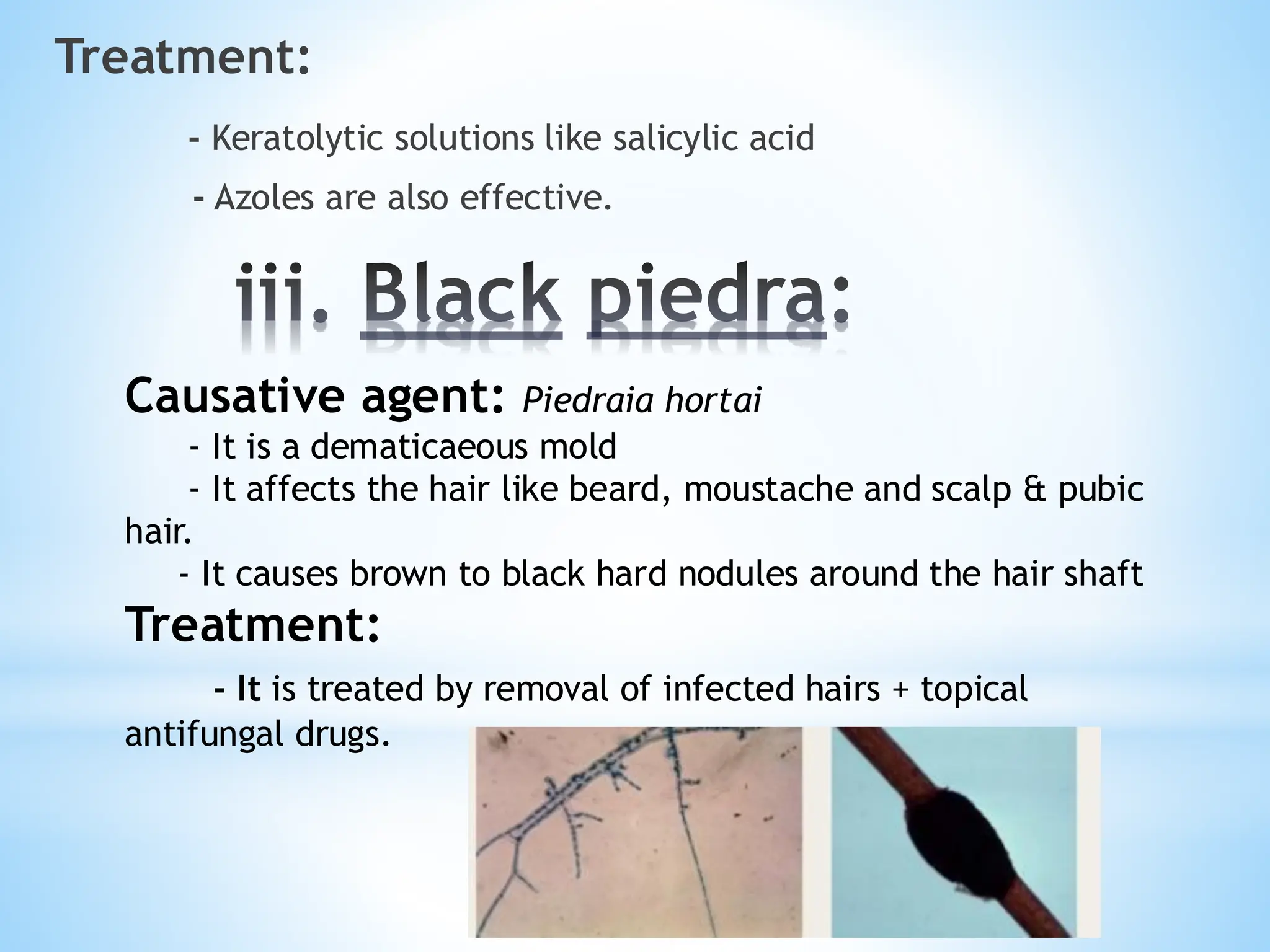 iii. Black piedra:
Treatment:
- Keratolytic solutions like salicylic acid
- Azoles are also effective.
Causative agent: Piedraia hortai
- It is a dematicaeous mold
- It affects the hair like beard, moustache and scalp & pubic
hair.
- It causes brown to black hard nodules around the hair shaft
Treatment:
- It is treated by removal of infected hairs + topical
antifungal drugs.
 