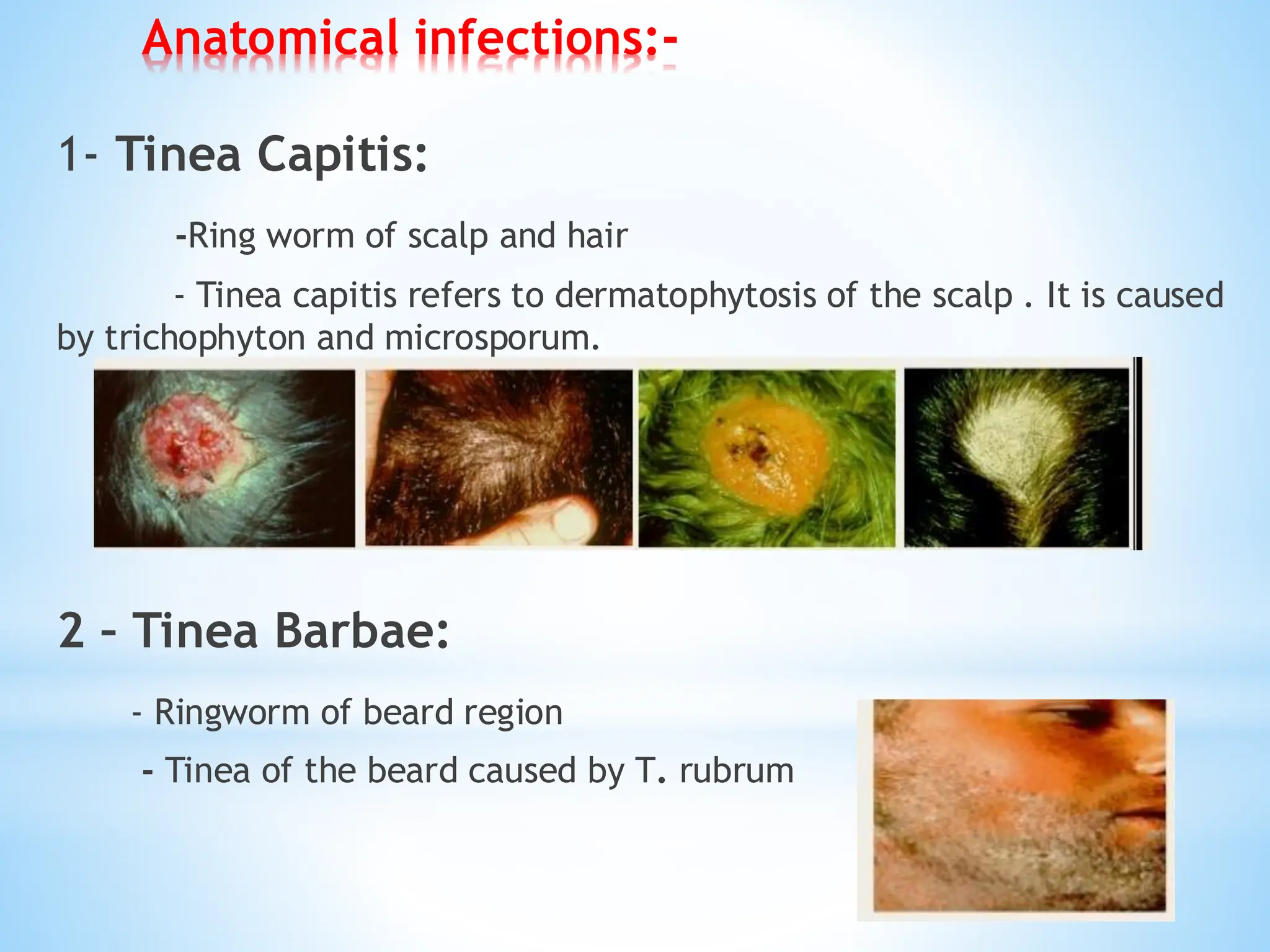 Anatomical infections:-
1- Tinea Capitis:
-Ring worm of scalp and hair
- Tinea capitis refers to dermatophytosis of the scalp . It is caused
by trichophyton and microsporum.
2 – Tinea Barbae:
- Ringworm of beard region
- Tinea of the beard caused by T. rubrum
 