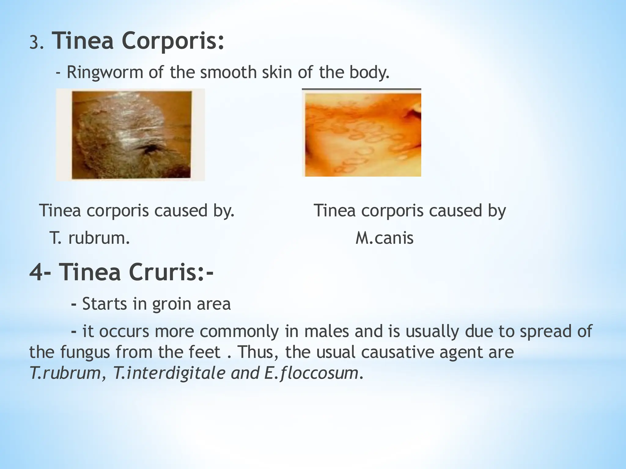 3. Tinea Corporis:
- Ringworm of the smooth skin of the body.
Tinea corporis caused by. Tinea corporis caused by
T. rubrum. M.canis
4- Tinea Cruris:-
- Starts in groin area
- it occurs more commonly in males and is usually due to spread of
the fungus from the feet . Thus, the usual causative agent are
T.rubrum, T.interdigitale and E.floccosum.
 