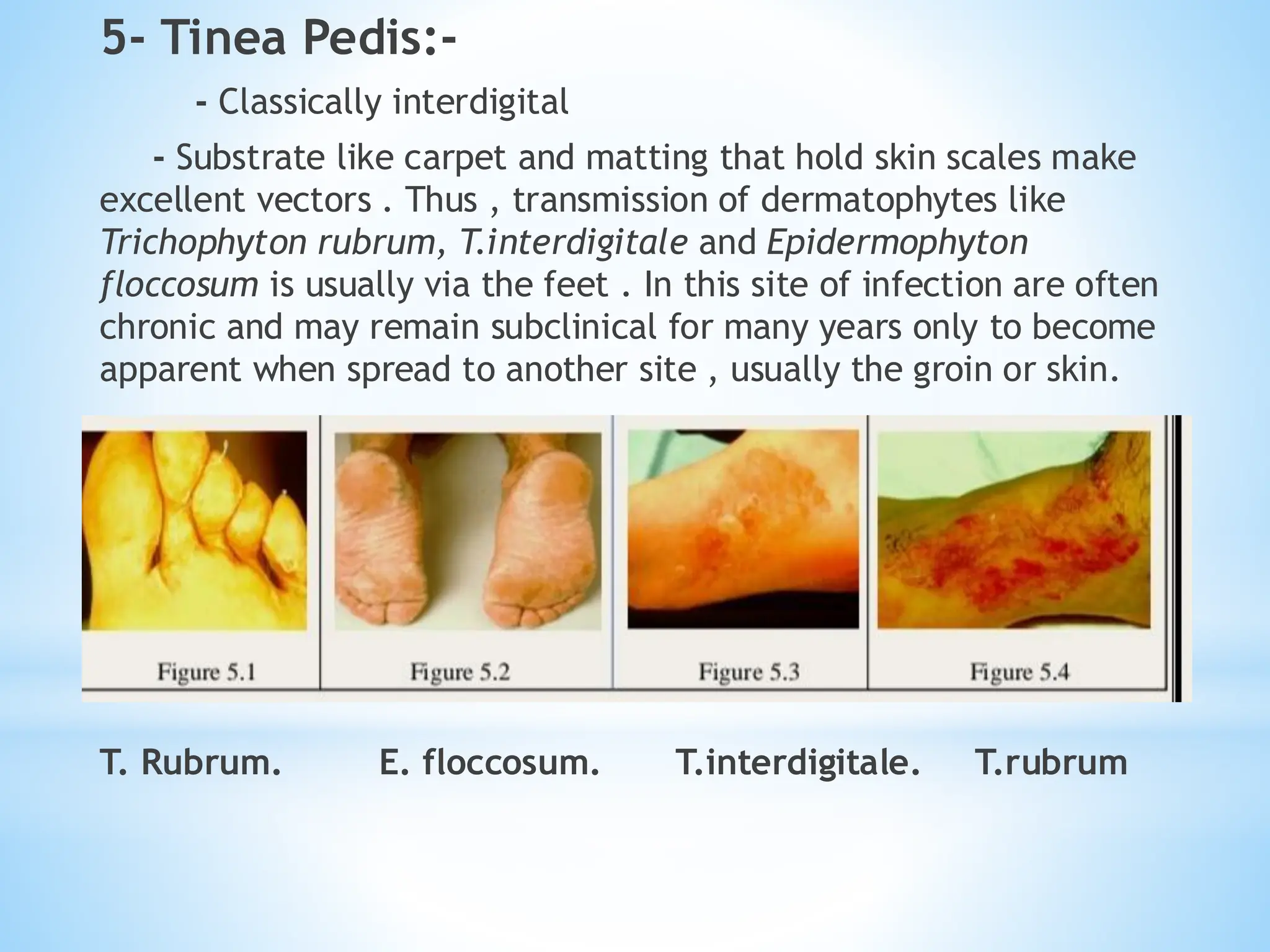 5- Tinea Pedis:-
- Classically interdigital
- Substrate like carpet and matting that hold skin scales make
excellent vectors . Thus , transmission of dermatophytes like
Trichophyton rubrum, T.interdigitale and Epidermophyton
floccosum is usually via the feet . In this site of infection are often
chronic and may remain subclinical for many years only to become
apparent when spread to another site , usually the groin or skin.
T. Rubrum. E. floccosum. T.interdigitale. T.rubrum
 