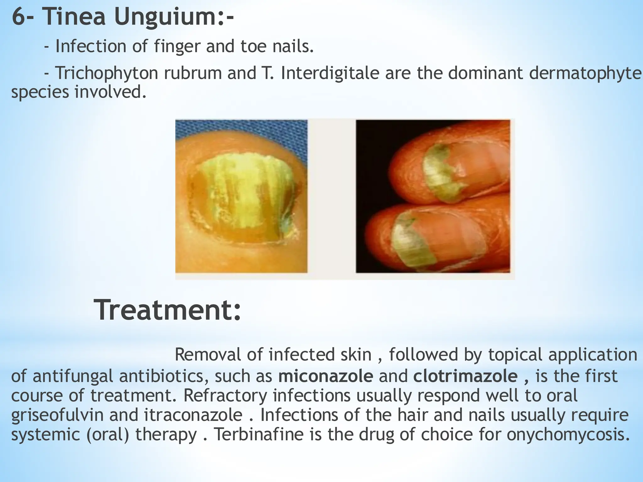 6- Tinea Unguium:-
- Infection of finger and toe nails.
- Trichophyton rubrum and T. Interdigitale are the dominant dermatophyte
species involved.
Treatment:
Removal of infected skin , followed by topical application
of antifungal antibiotics, such as miconazole and clotrimazole , is the first
course of treatment. Refractory infections usually respond well to oral
griseofulvin and itraconazole . Infections of the hair and nails usually require
systemic (oral) therapy . Terbinafine is the drug of choice for onychomycosis.
 