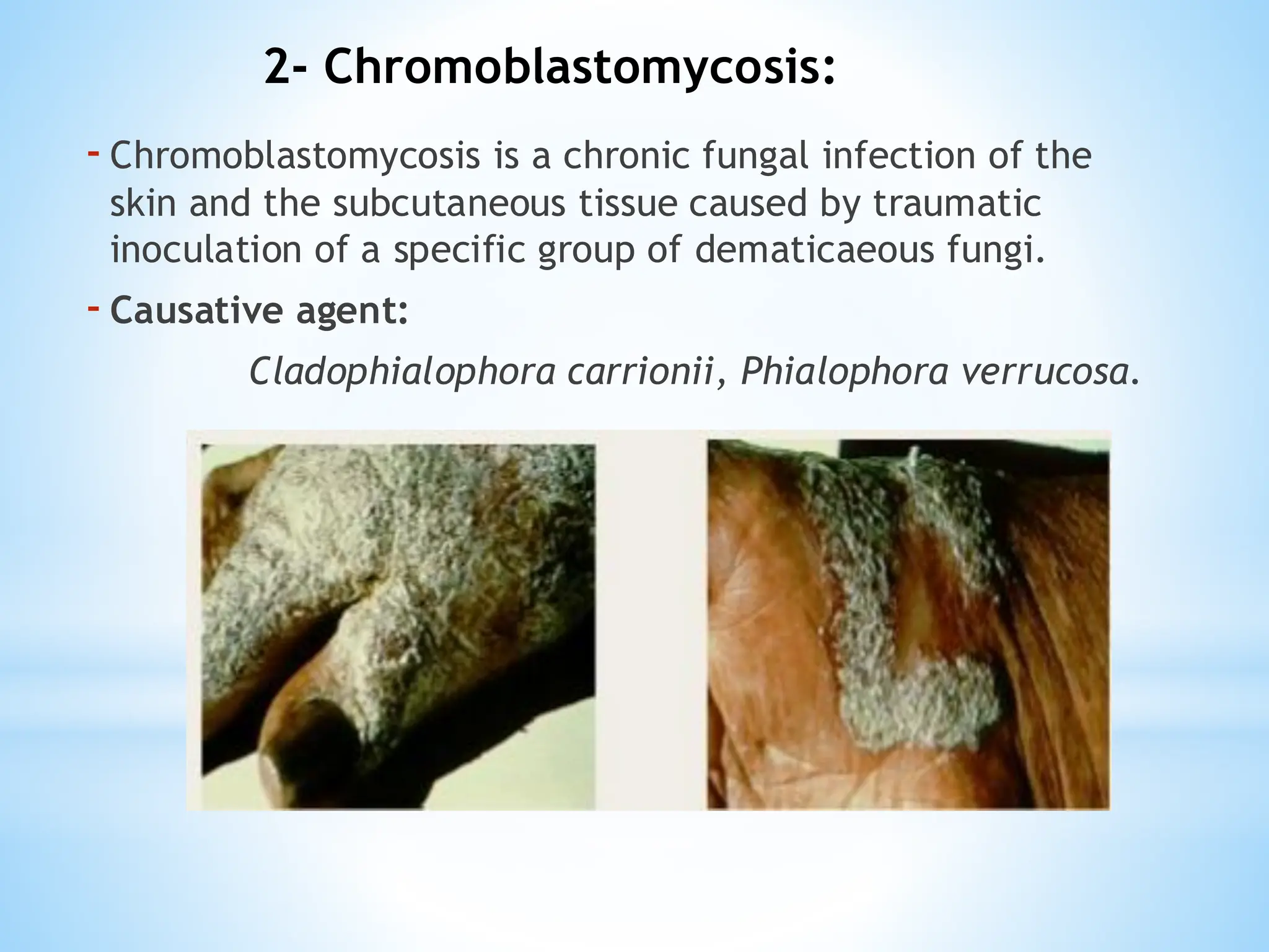 -Chromoblastomycosis is a chronic fungal infection of the
skin and the subcutaneous tissue caused by traumatic
inoculation of a specific group of dematicaeous fungi.
-Causative agent:
Cladophialophora carrionii, Phialophora verrucosa.
2- Chromoblastomycosis:
 