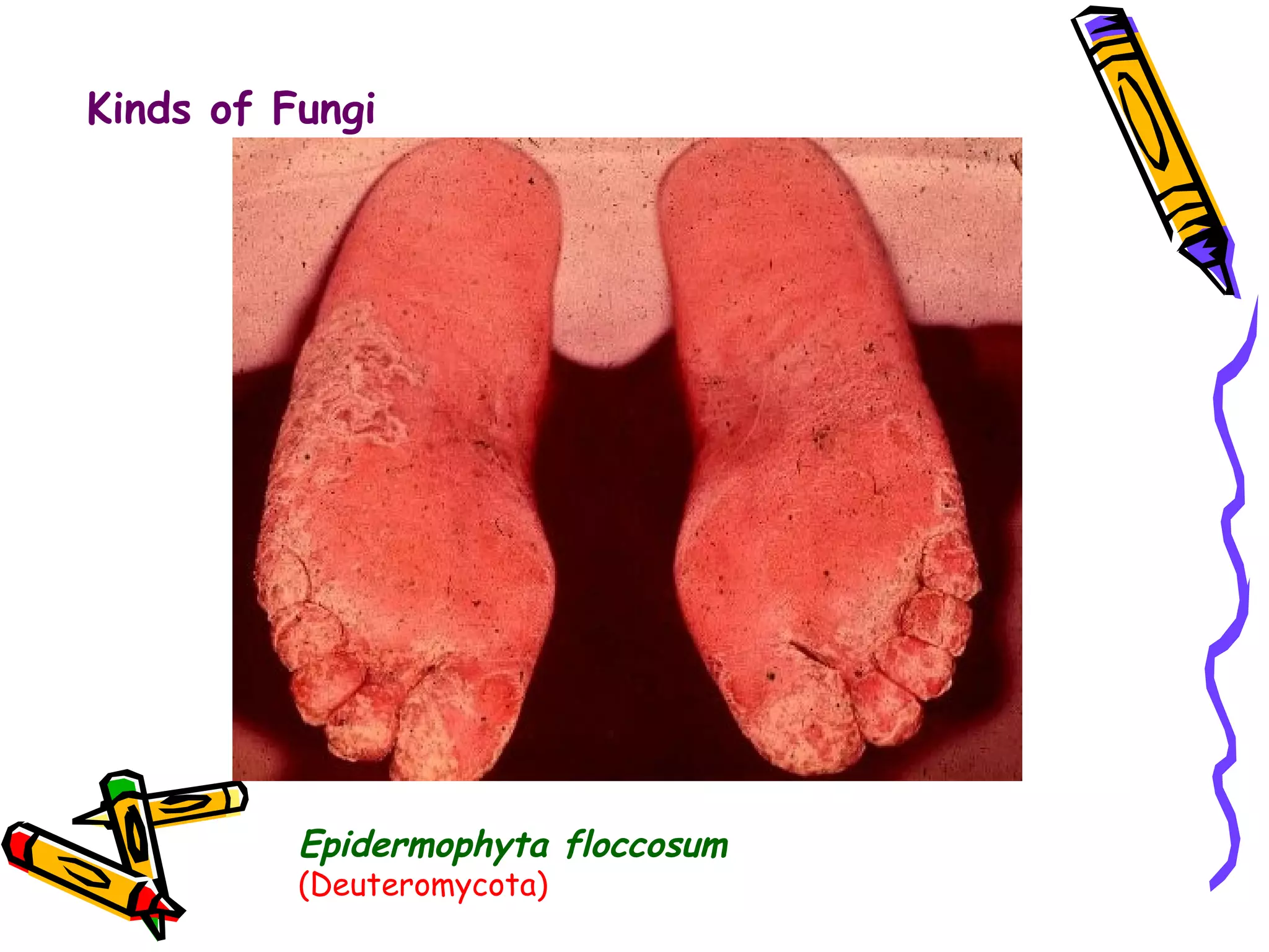 Kinds of Fungi Epidermophyta floccosum   (Deuteromycota) 