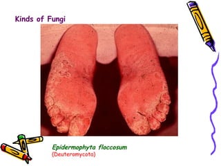 Kinds of Fungi Epidermophyta floccosum   (Deuteromycota) 