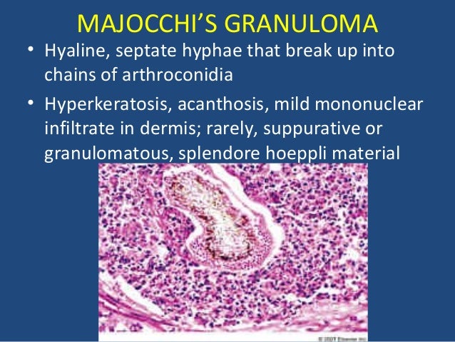 Fungi in tissue sectio...