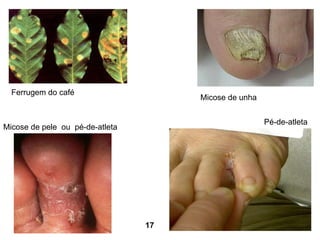 Ferrugem do café Micose de unha Micose de pele  ou  pé-de-atleta Pé-de-atleta 17   