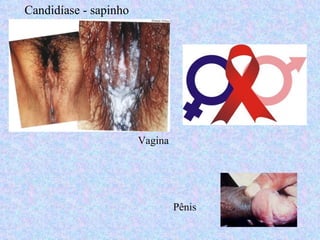 Candidíase - sapinho




                       Vagina




                                Pênis
 