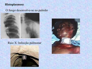 Histoplasmose
O fungo desenvolve-se no pulmão




 Raio X: Infecção pulmonar
 