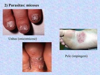 2) Parasitas: micoses




  Unhas (onicomicose)




                        Pele (impingem)
 