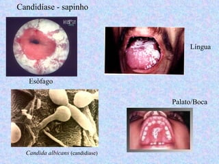 Candidíase - sapinho



                                       Língua



   Esôfago

                                  Palato/Boca




  Candida albicans (candidíase)
 
