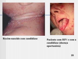 Recém-nascido com candidíase   Paciente com HIV e com a
                               candidíase (doença
                               oportunista)


                                                  18
 