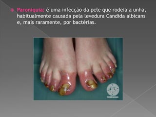 

Paroníquia: é uma infecção da pele que rodeia a unha,
habitualmente causada pela levedura Candida albicans
e, mais raramente, por bactérias.

 