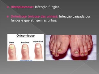 

Histoplasmose: Infecção fungica.



Onimicose (micose das unhas): Infecção causada por
fungos e que atingem as unhas.

 