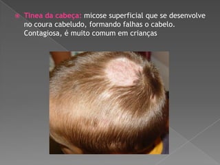 

Tinea da cabeça: micose superficial que se desenvolve
no coura cabeludo, formando falhas o cabelo.
Contagiosa, é muito comum em crianças

 