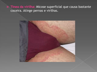 

Tinea da virilha: Micose superficial que causa bastante
coceira. Atinge pernas e virilhas.

 
