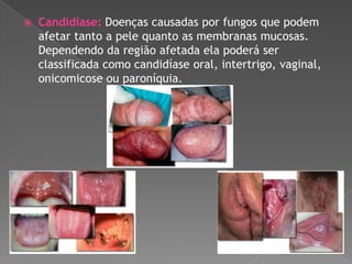 

Candidíase: Doenças causadas por fungos que podem
afetar tanto a pele quanto as membranas mucosas.
Dependendo da região afetada ela poderá ser
classificada como candidíase oral, intertrigo, vaginal,
onicomicose ou paroníquia.

 