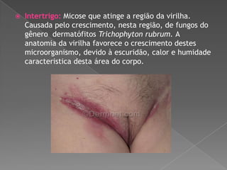 

Intertrigo: Micose que atinge a região da virilha.
Causada pelo crescimento, nesta região, de fungos do
gênero dermatófitos Trichophyton rubrum. A
anatomia da virilha favorece o crescimento destes
microorganismo, devido à escuridão, calor e humidade
caracteristica desta área do corpo.

 